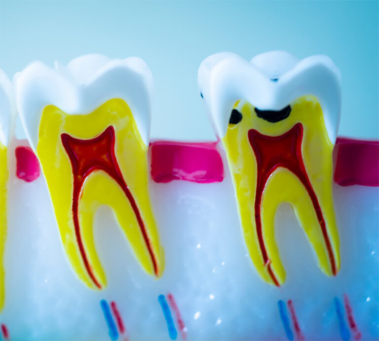 root-canal-treatment-in-brampton-root-canal-treatment-near-you